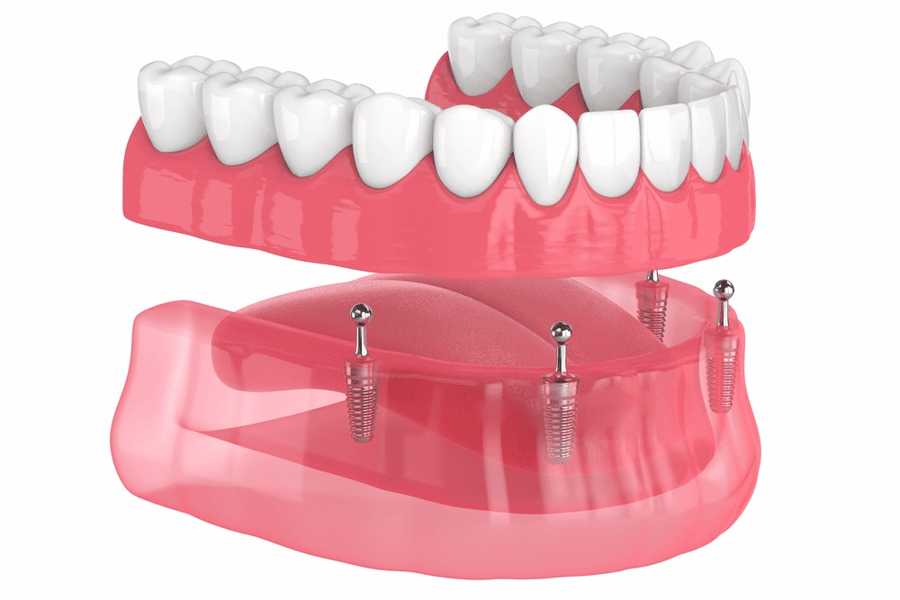 Full arch of teeth supported by four dental implants