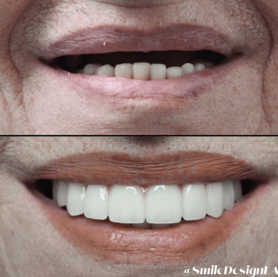 Before and after smile transformation
