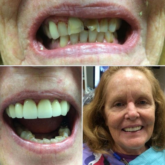 Before and after smile transformation with patient portrait
