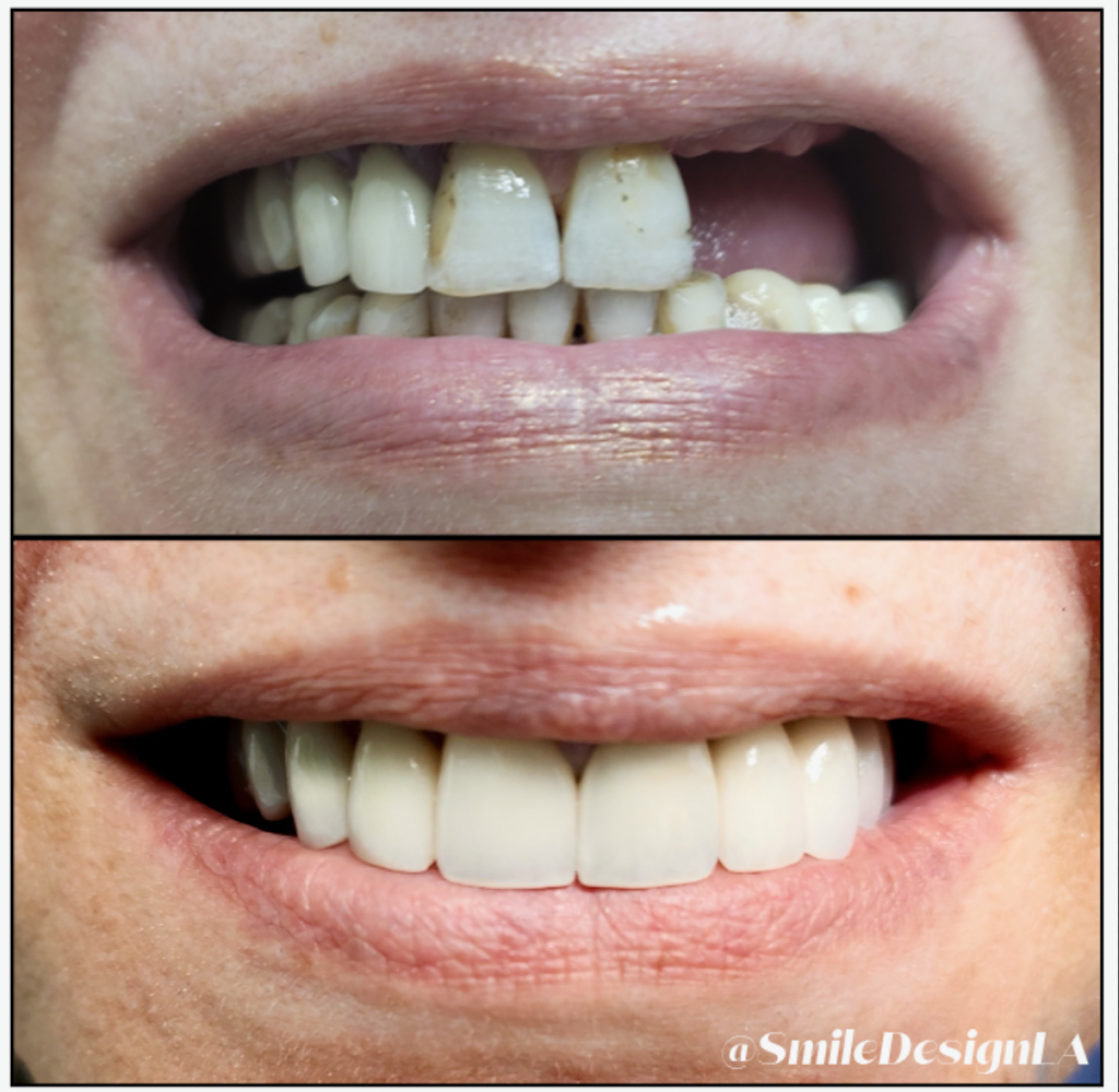 Before: worn and missing upper teeth. After: bright, even restored upper teeth