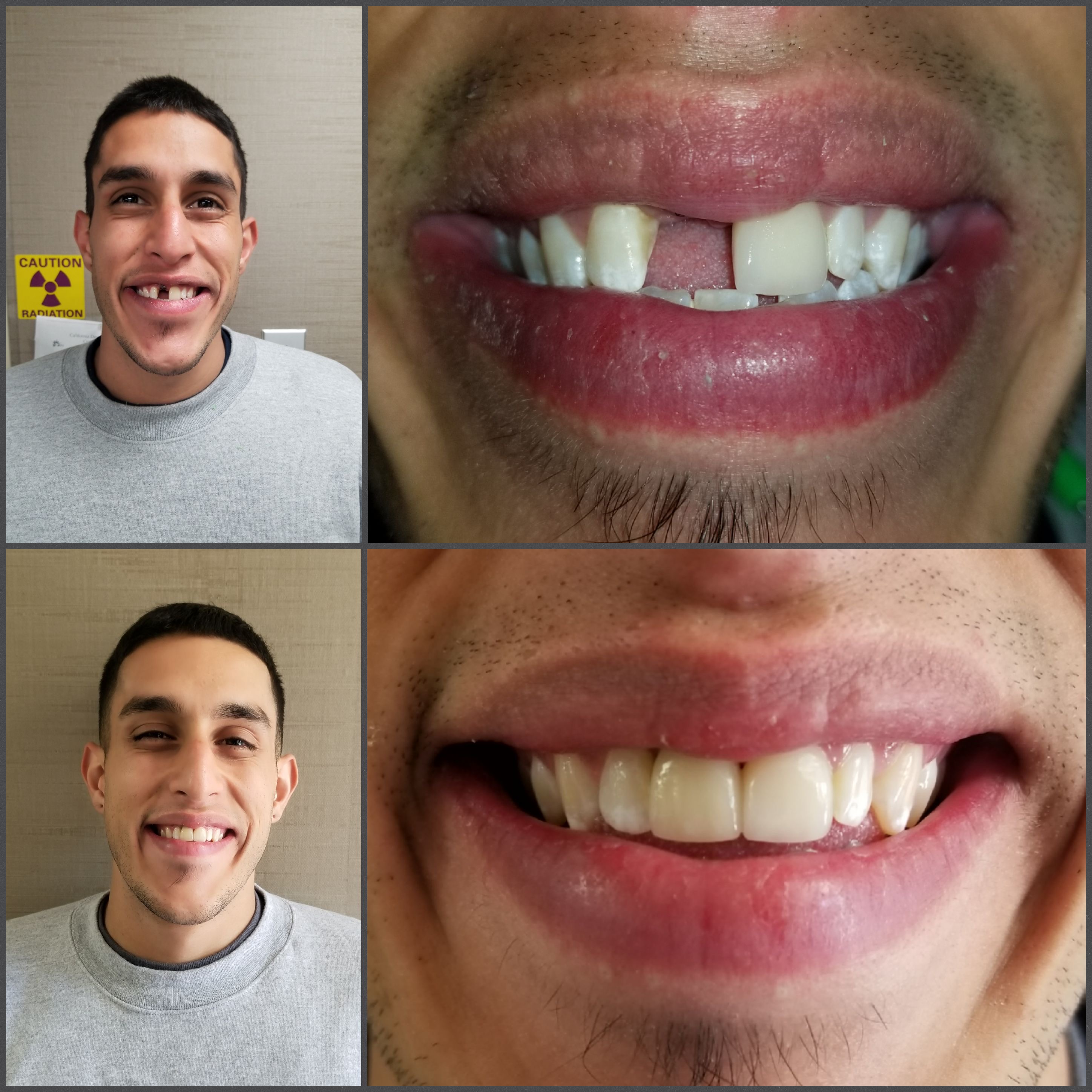 Patient before with a missing front tooth and after with a complete, natural smile