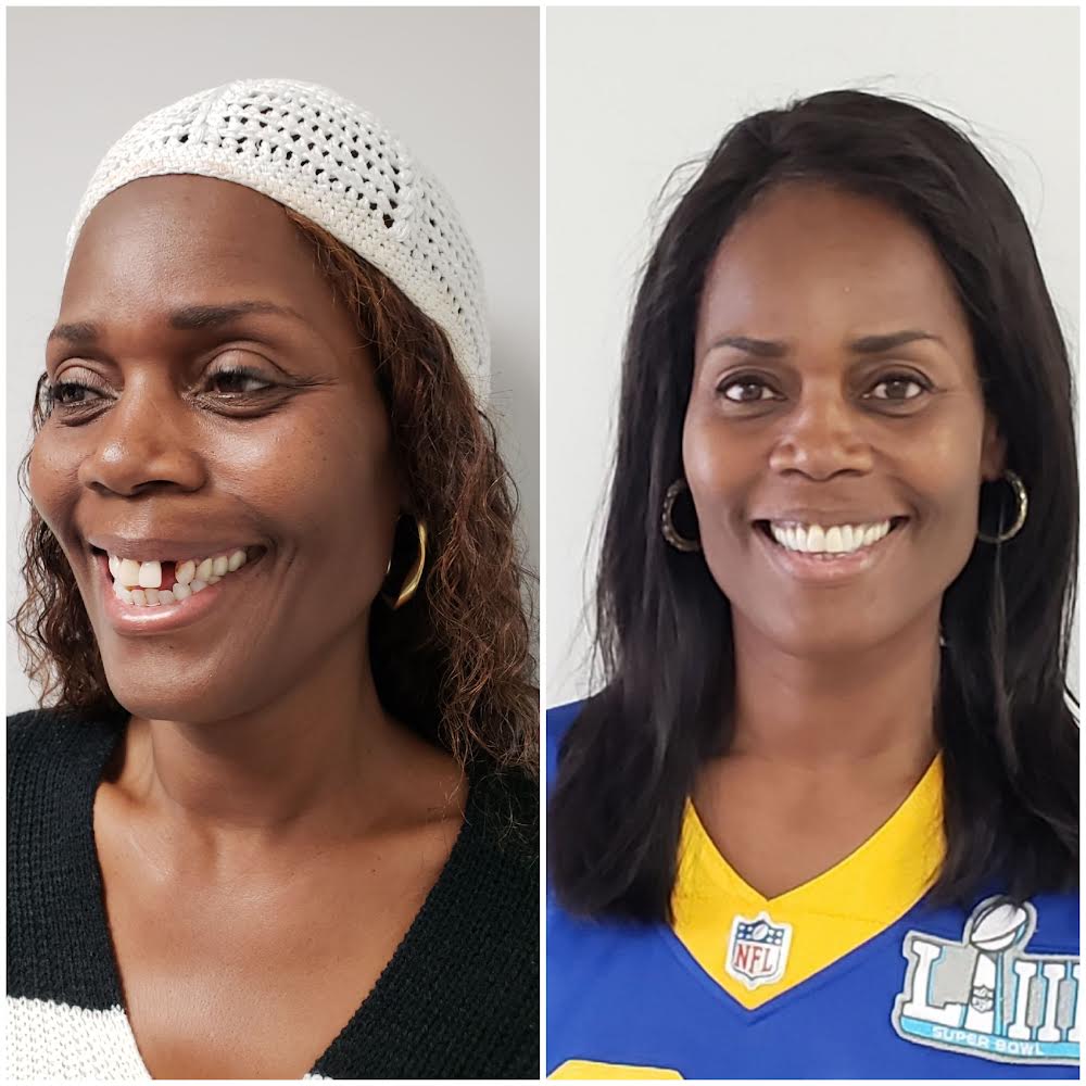 Patient before with a gap from a missing front tooth and after with a full, even smile