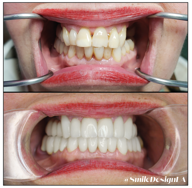 Before: stained, worn teeth. After: bright white full upper and lower restoration