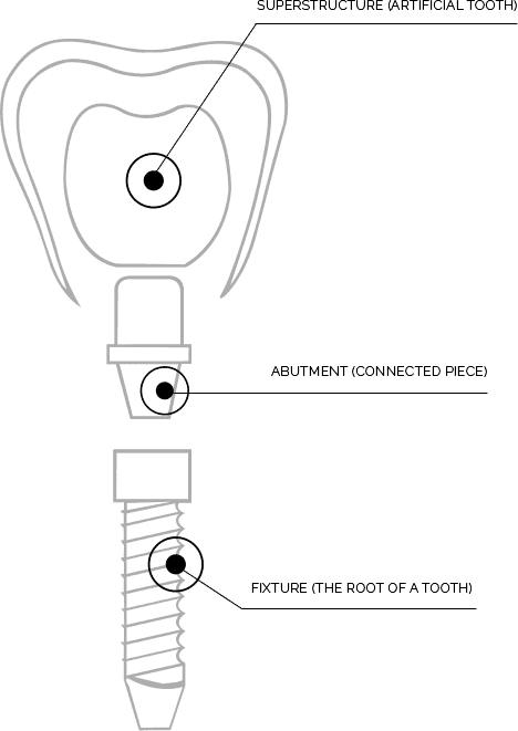 Diagram of a dental implant: crown, abutment, and titanium fixture