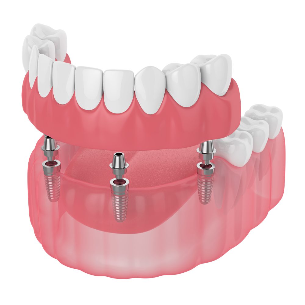 Denture secured by four mini dental implants